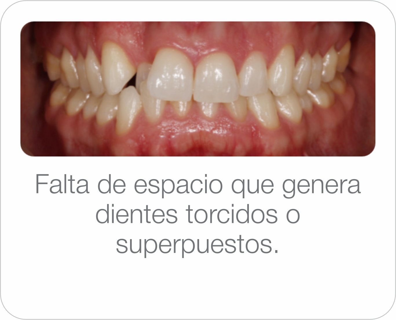 Caso real - Apiñamiento